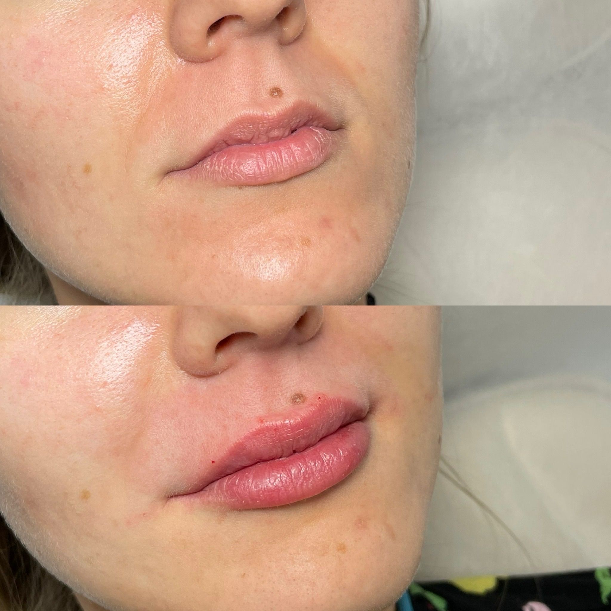 Lip Filler London – Natural Lip Enhancement & Lip Augmentation